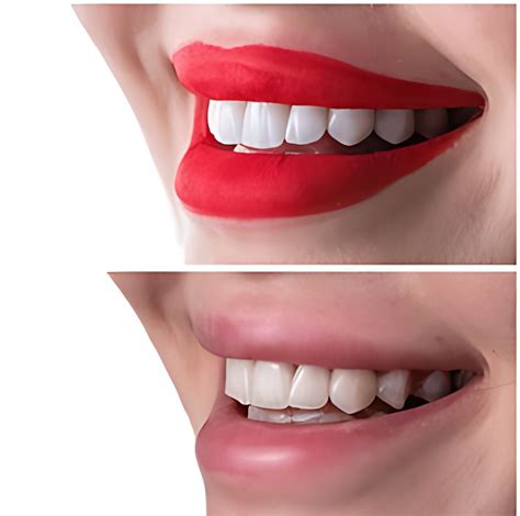 Emax Empress Veneer Turkey Antalya Cost Beforeandafter Review