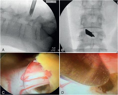 Scielo Brasil Evaluation Of Lumbar Endoscopic Discectomy In Obese