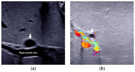 Diagnostics Free Full Text Ultrasound For The Diagnosis Of Biliary