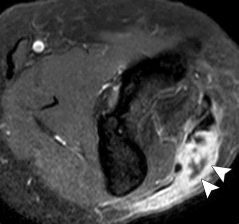 Mr Imaging In The Evaluation Of Cystic Appearing Soft Tissue Masses Of