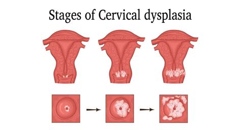 Cervical Dysplasia Dr Sandra Cabot Md