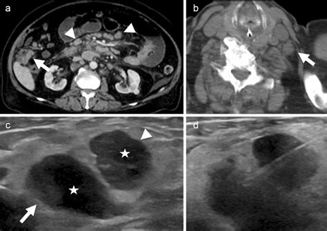 A 72 Year Old Male With Signet Ring Cell Carcinoma Of The Colon Ct Of Download Scientific