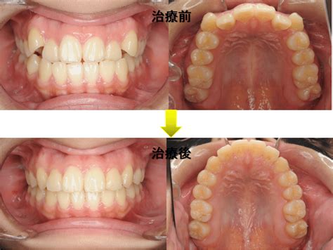 歯列矯正 抜歯 小顔 155309