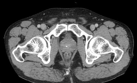 Figure 3 from Prostate Stones | Semantic Scholar