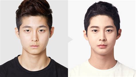 Tl Plastic Surgery Clinic Korea Male Plastic Surgery Beforeandafter★