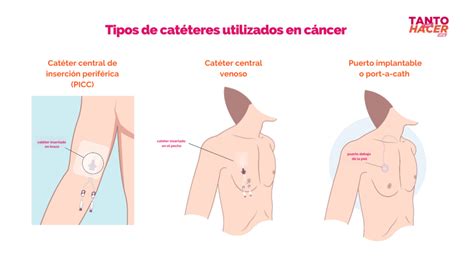 Cosas Que Debes Saber Sobre El Uso De Cat Teres Y Puertos En C Ncer