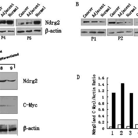 Expression Of Ndrg2 And C Myc Protein In Cancerous Tissues Adjacent