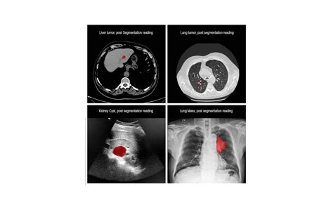 RSIP Vision Announces Versatile Medical Image Segmentation Tool Axis