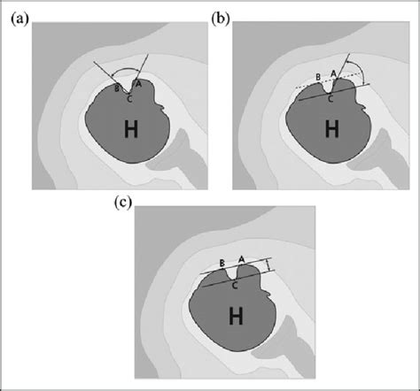 Measurement of the morphologic characteristics of the bicipital groove... | Download Scientific ...