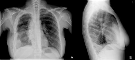 Chest X Ray On Posterior Anterior A And Lateral B Views