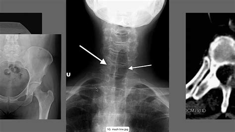 Lumbar Spine Xray Anatomy