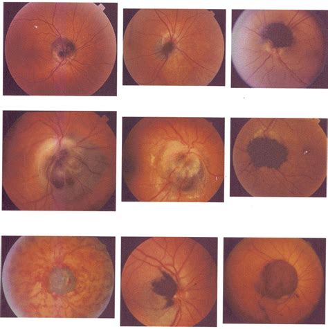 Melanocytoma Of Optic Disc In 115 Cases Ophthalmology