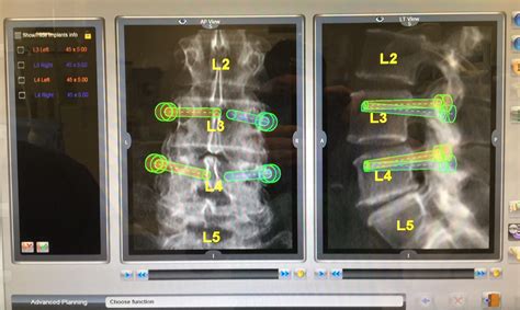 Artificial Disc Surgery Lumbar Discectomy Australia C N S Neurosurgery