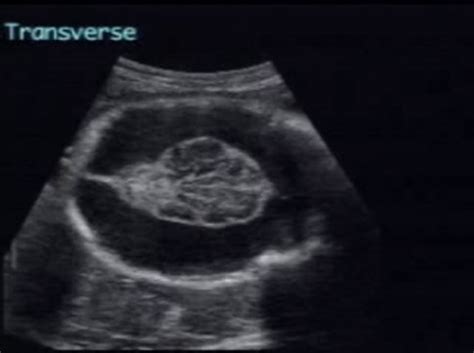 Porencephaly Ultrasoundpaedia