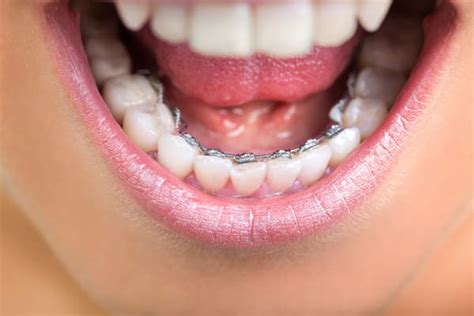 Lakewood Co Lingual Braces Cost Inbrace Price Belmar Orthodontics