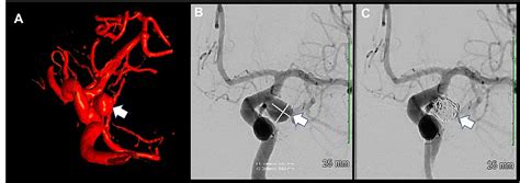 Catheter Angiogram Of The Brain A Three Dimensional Rotational Download Scientific Diagram