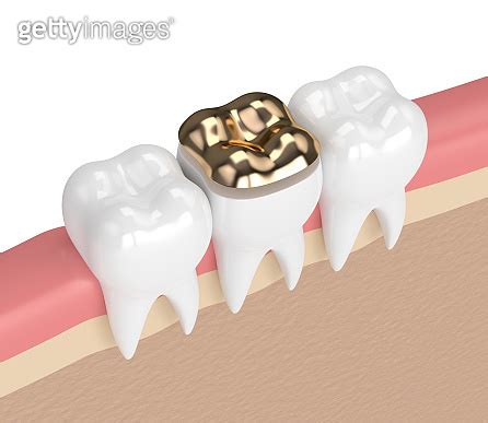 D Render Of Teeth With Dental Golden Onlay Filling