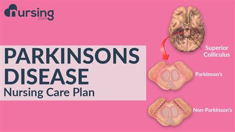 Nursing Care Plan For Parkinson S Disease Nursing Care Plan Tutorial