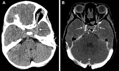 Imaging The Cerebral Veins In Pediatric Patients Beyond Dural Venous Sinus Thrombosis