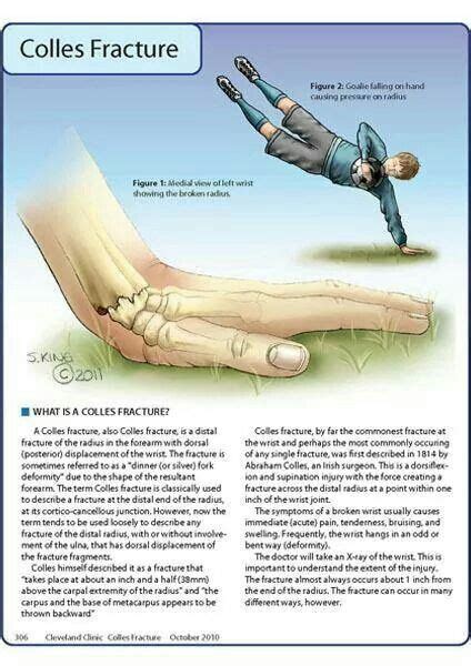 33 best Colles Fracture images on Pinterest | Hand therapy, Bones and ...