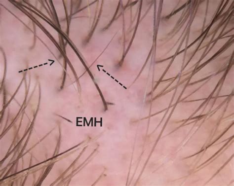 Alopecia Areata Up Close A Look At Exclamation Mark Hairs — Donovan Hair Clinic