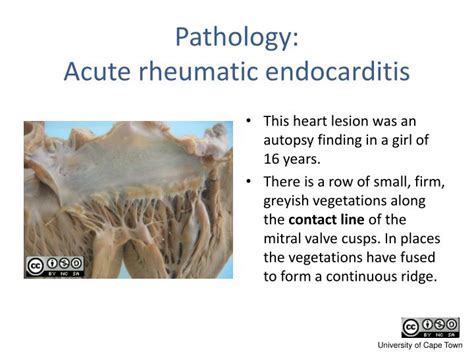 Ppt Rheumatic Heart Disease Powerpoint Presentation Id 5663159