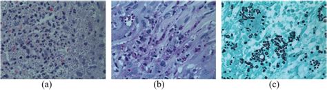 Biopsy From November 2018 A Hematoxylin And Eosin Stain