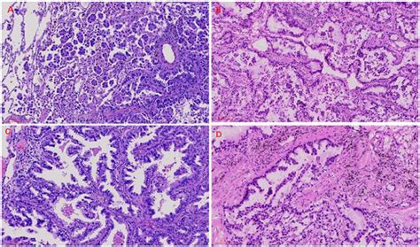 EP11 03 004 Identification Of Filigree Pattern Increases Diagnostic