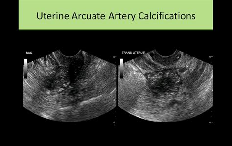 Arcuate Artery