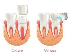 Dental Crowns Vs Veneers Understanding The Differences