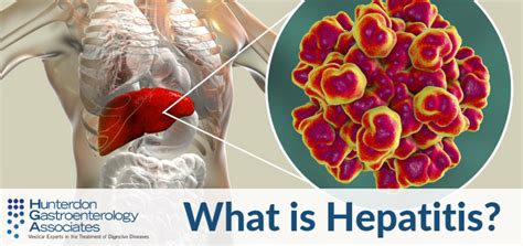 What Is Hepatitis Hunterdon Gastroenterology Associates Digestive