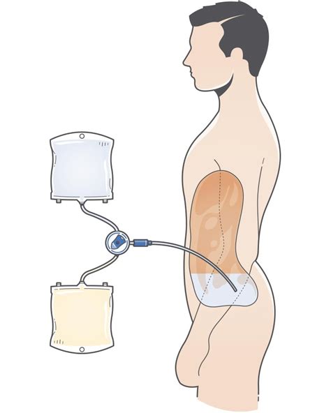 Peritoneal Dialysis Capd Gayatri Pharmaceuticals