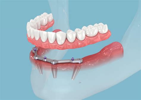 Mastering All On Four Implants A Comprehensive Guide To Pre Procedure