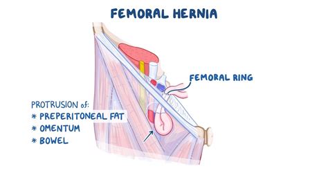 Female Femoral Hernia Images