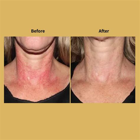 Laser Skin Rejuvenation In Portland Or Soleil Medical Spa