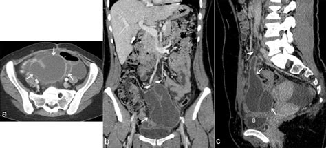 Multilocular Peritoneal Inclusion Cyst A Diagnostic Challenge Eurorad