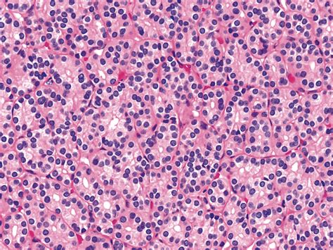 Follicular Adenoma Thyroid