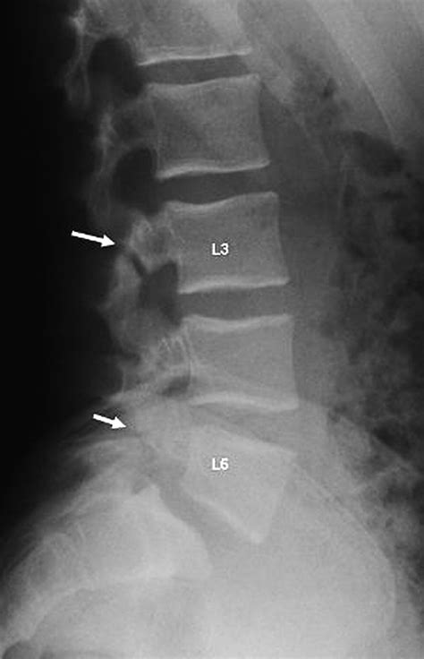 The Imaging And Management Of Nonconsecutive Pars Interarticularis Defects A Case Report And