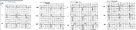 Dr Smith S ECG Blog A 50 Something With H O Coronary Bypass Has Chest