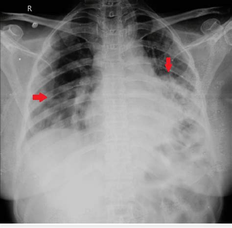 A Chest X Ray Posteroanterior Pa View Of The Patient Showing Fluffy