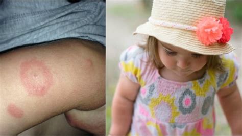 Lyme Disease On The Rise In Canada But Doctors Still Confused About Diagnosis Cbc News