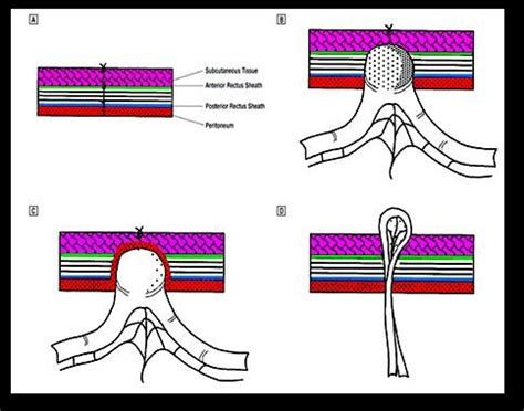 Classification Of The Trocar Site Hernias A Normal Stab Wound Of