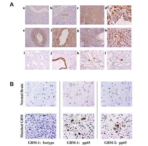 A Immunohistochemical Detection Of Human Cytomegalovirus Hcmv