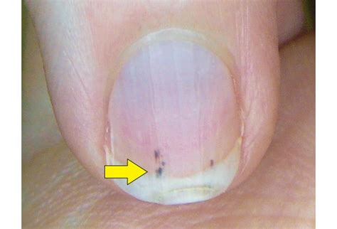 Fingernail and Toenail Abnormalities: Nail the Diagnosis