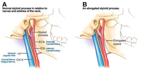 What Is Eagle Syndrome Causes Best Treatment