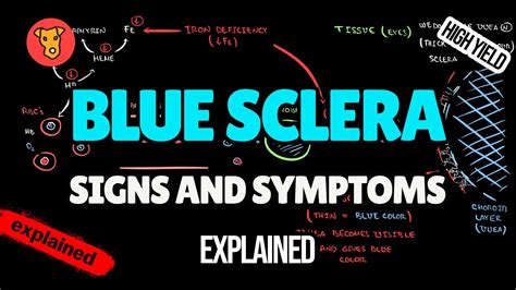 Blue Sclera Pathogenesis Of Signs And Symptoms In Medicine Youtube