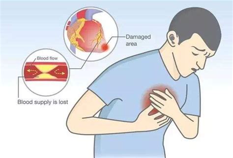 关爱生命，远离心梗！心梗症状患者出现表现 健康界