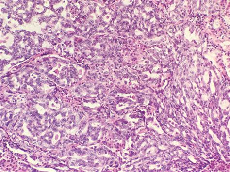 Histological Findings Of Lung Adenocarcinomas With MLCs The MLCs Were