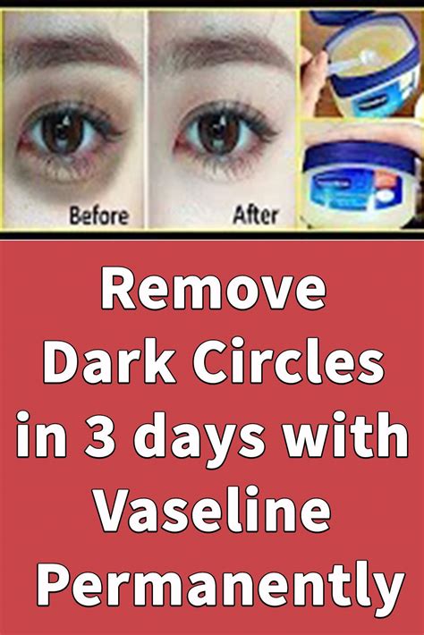 Remove Dark Circles In 3 Days With Vaseline Permanently Dark Circles