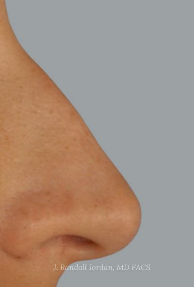 Rhinoplasty Case Faces Pllc In Ridgeland Ms